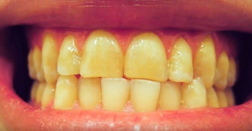 get rid yellow teeth naturally